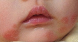 宝宝春季预防湿疹的措施有哪些？