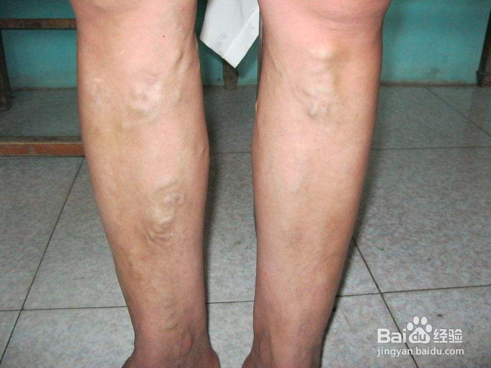 什么是静脉曲张