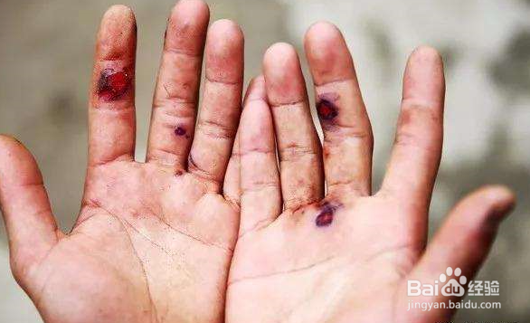 受伤时候如何快速止血