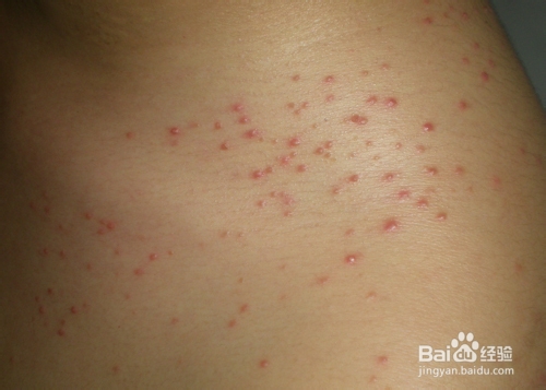 头皮毛囊炎应该如何预防