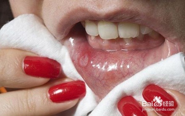 复发性口腔溃疡是什么