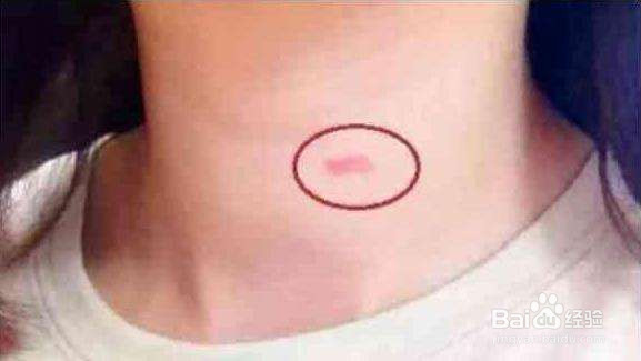 草莓印怎么消除？