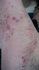 脚部湿疹症状有哪些_最佳治疗方法 【图文】