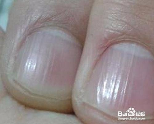手指甲有点泛白是什么原因