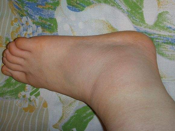 为何脚冻坏了会痒痒