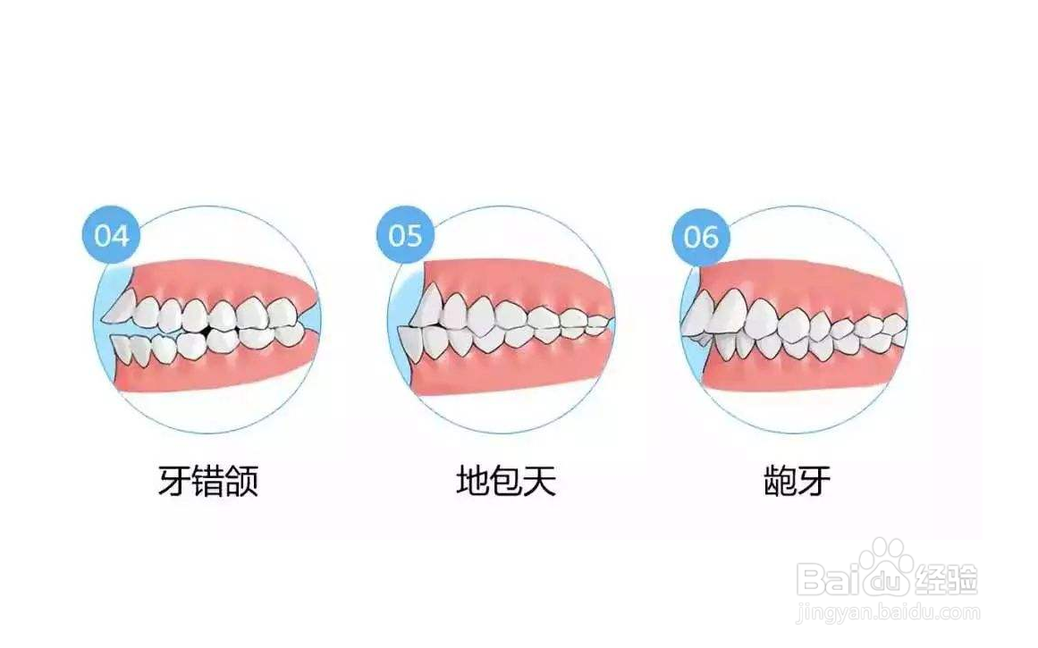 整完牙为什么要带保持器？