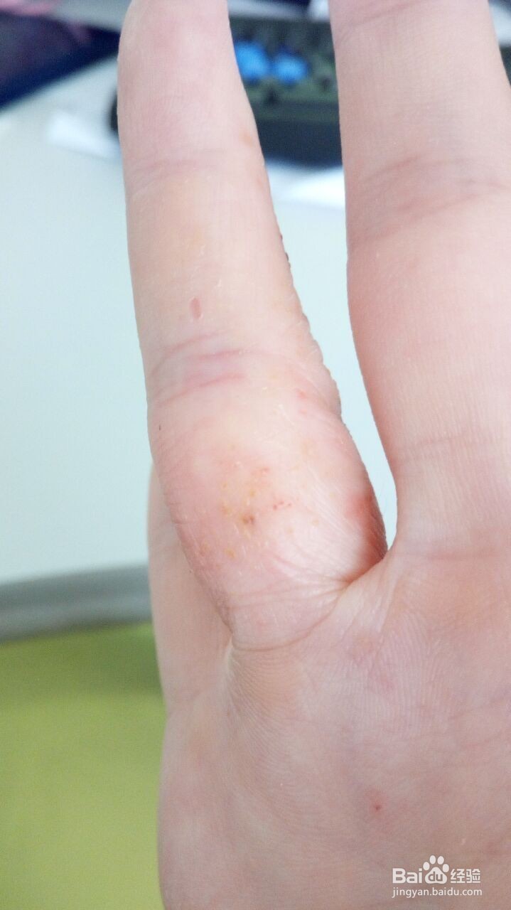 手指小水泡的治疗过程（真实经验）