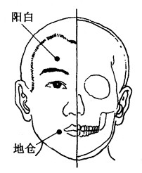 百病拔罐：[27]面瘫的拔罐疗法