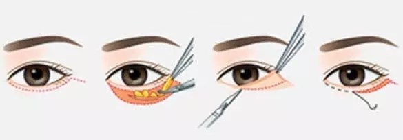 出现眼袋怎么办