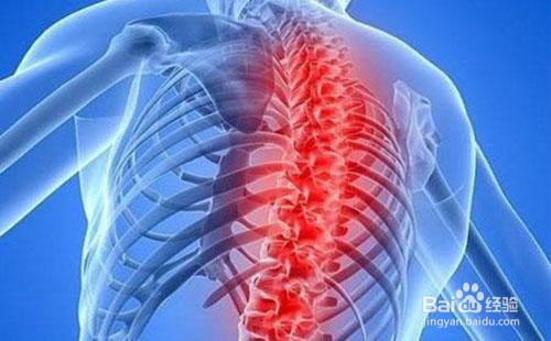 强直脊柱炎怎么锻炼