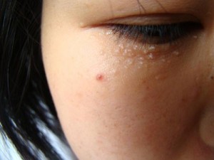 4招教你速度去除脂肪粒、眼纹、眼带、黑眼圈