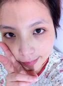 鼻炎也会导致黑眼圈的出现