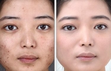 如何快速治疗青春豆