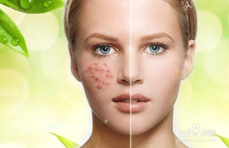 皮肤深层痘菌怎么清除