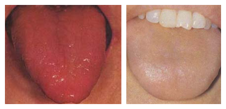 肾阴虚与肾阳虚的简易的区分方法