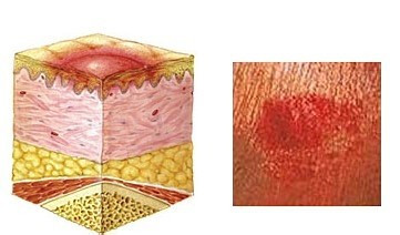 褥瘡的症狀是什麼-百度經驗