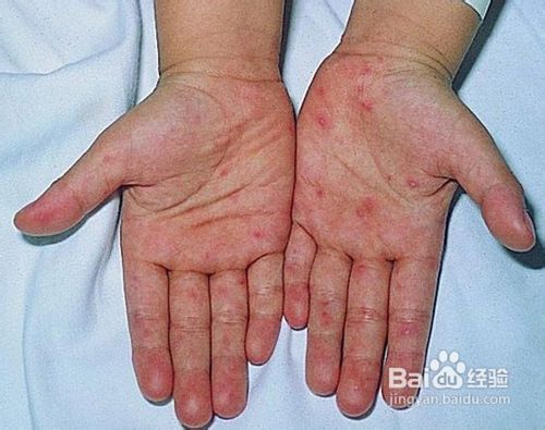 乙肝患者有哪些症状