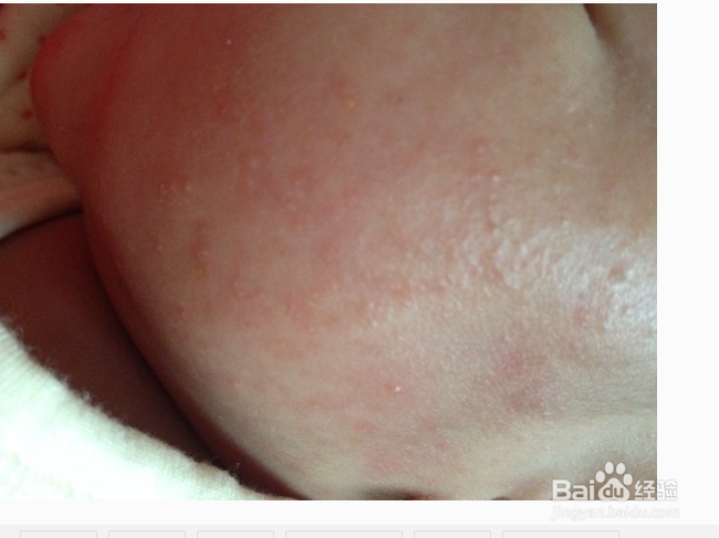 春季刮大风脸上起了好多豆豆咋办