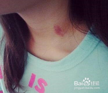 怎样自己制造吻痕