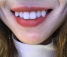 牙黄不用洗牙，用这个方法，牙垢脱落口气清新！