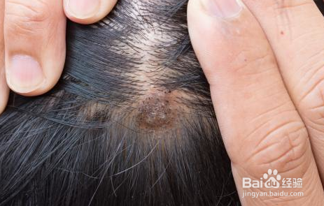 防脱经验，治疗脱发都有哪些方法，怎么选择