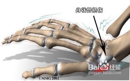 手腕扭伤了怎么办