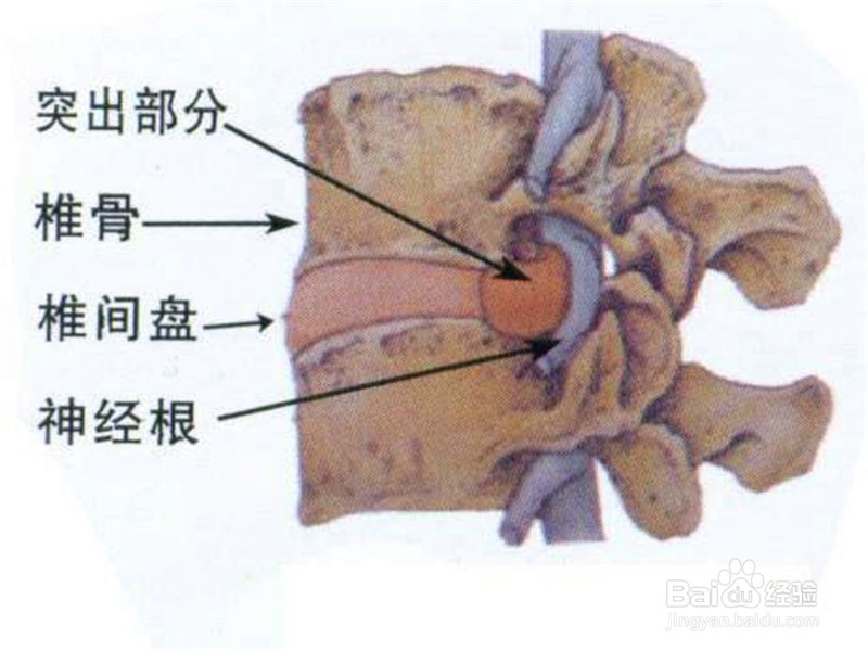 如何预防腰间盘突出