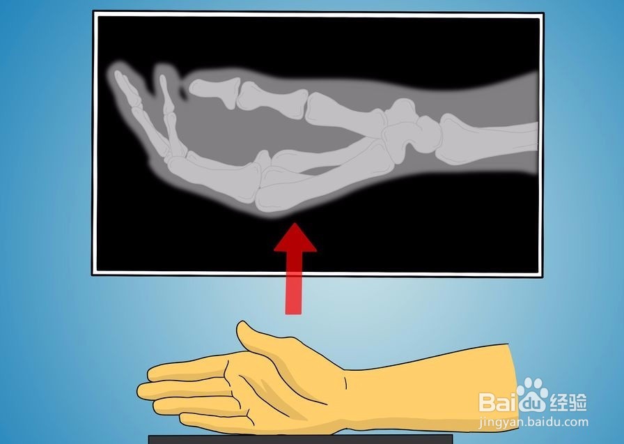 如何诊断拇指是否骨折?
