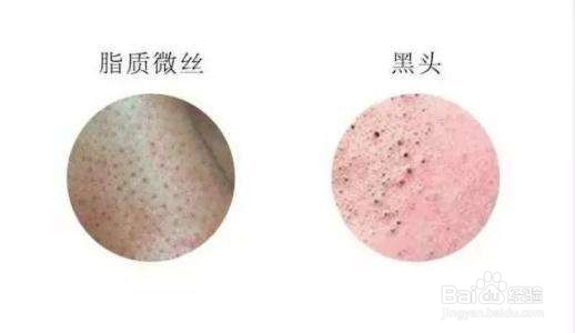 螨虫脸有什么症状？怎样有效去除螨虫？