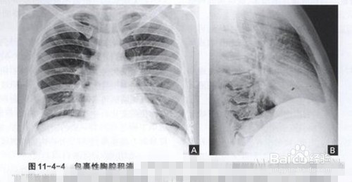 胸膜炎与脓胸有哪些症状？