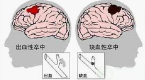 从身边做起：重视脑卒中