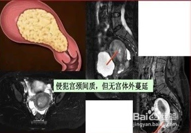 子宫内膜癌病例分析