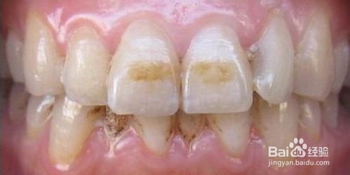 氟斑牙的危害有哪些