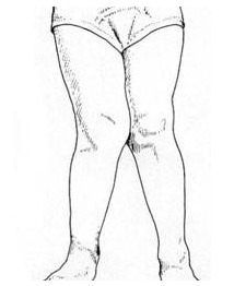 孩子缺钙的表现和症状有哪些