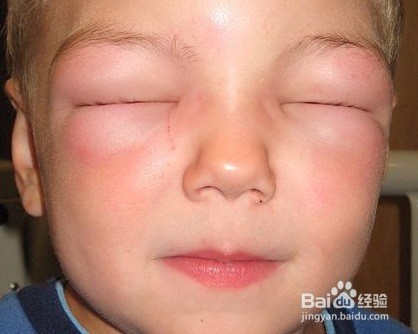 食物过敏与荨麻疹 自我检测指南