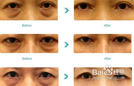 祛眼袋[1]祛眼袋的方法