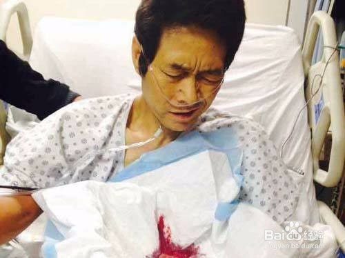 胆管细胞癌晚期死前征兆