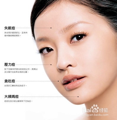 痘痘篇：[5]痘痘生长的地方能显示身体的毛病