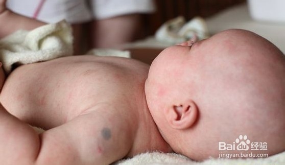 幼儿急疹护理:记宝宝第一次发烧幼儿急疹经历