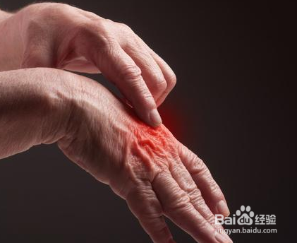 风湿关节炎和痛风有什么区别