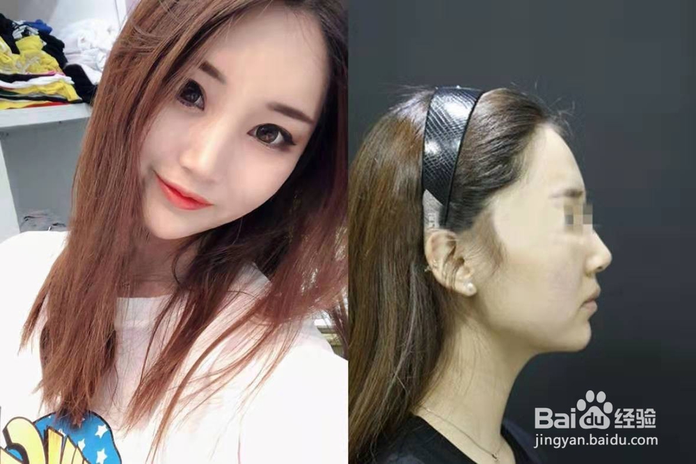 我做了线雕眼袋后多久可以化妆怕出现副作用!