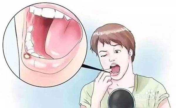 出现口腔溃疡的解决办法