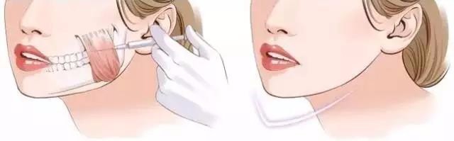 瘦脸针打三次能定型吗？