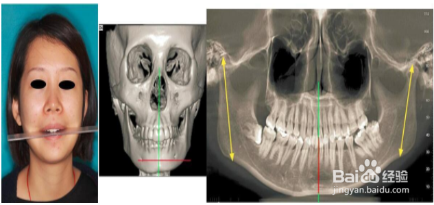 如何分辨髁突肥大