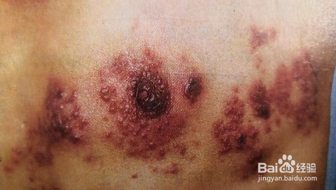 带状疱疹的症状