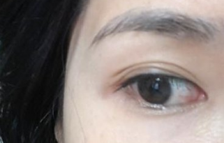 三眼皮怎样变回双眼皮