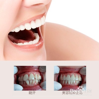 龅牙矫正后该如何护理