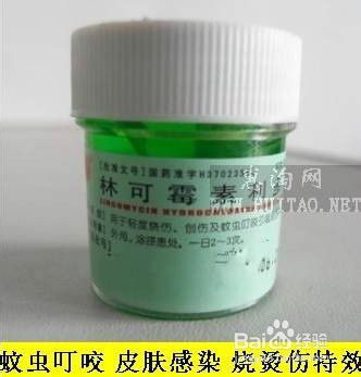 如何治疗蚊虫叮咬