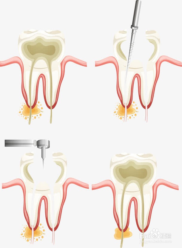 合肥补牙多少钱一颗