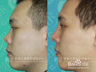 短鼻、朝天鼻 前后对比照片